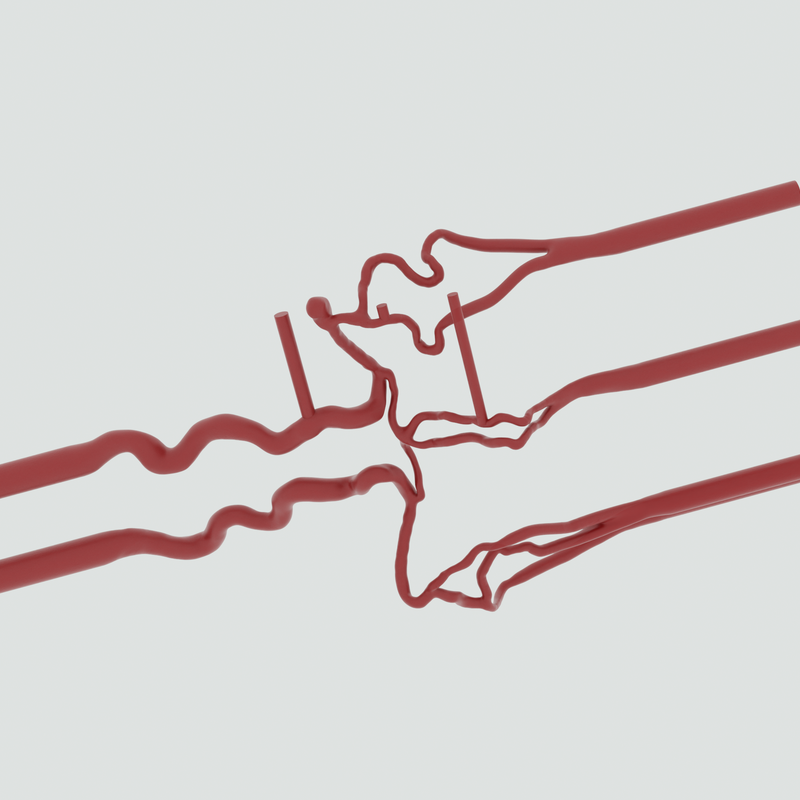 Image of Cerebral Thrombectomy